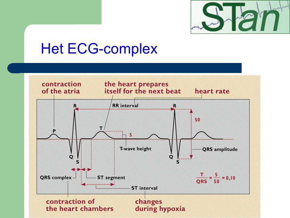 Het ECG-complex